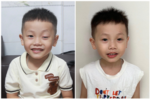 Bệnh viện đa khoa Việt Đức phẫu thuật sụp mi bẩm sinh cho bé trai 4 tuổi