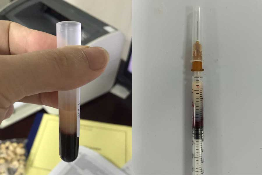 Điều trị Viêm tụy cấp do tăng Triglycerid máu tại Bệnh viện đa khoa Việt Đức