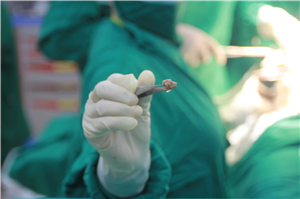Bệnh viện Đa khoa Việt Đức phẫu thuật mở ống tụy lấy sỏi, nối tụy ruột