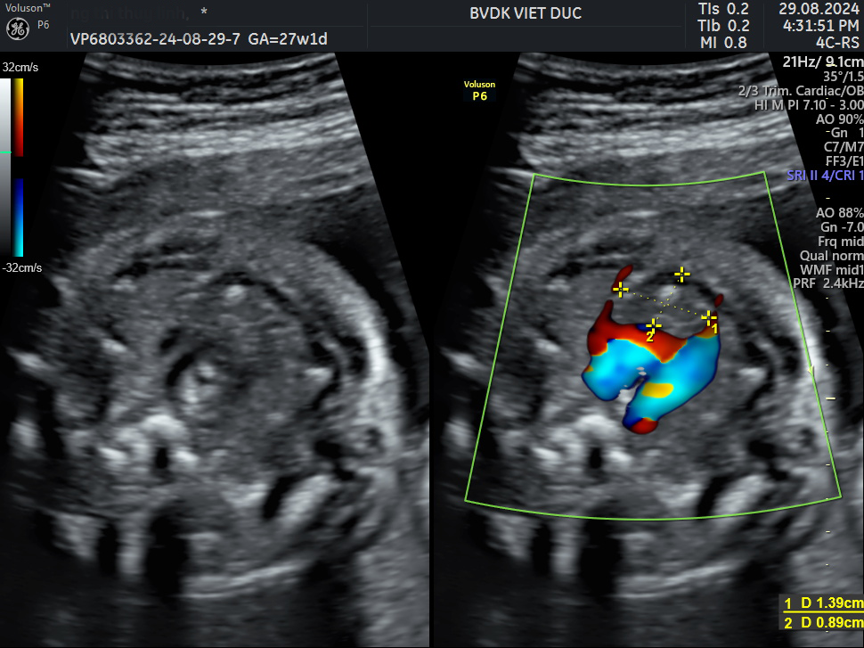 Phát hiện bất thường cung động mạch chủ bên phải ở thai nhi tại Bệnh viện Đa khoa Việt Đức