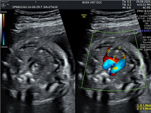 Phát hiện bất thường cung động mạch chủ bên phải ở thai nhi tại Bệnh viện Đa khoa Việt Đức