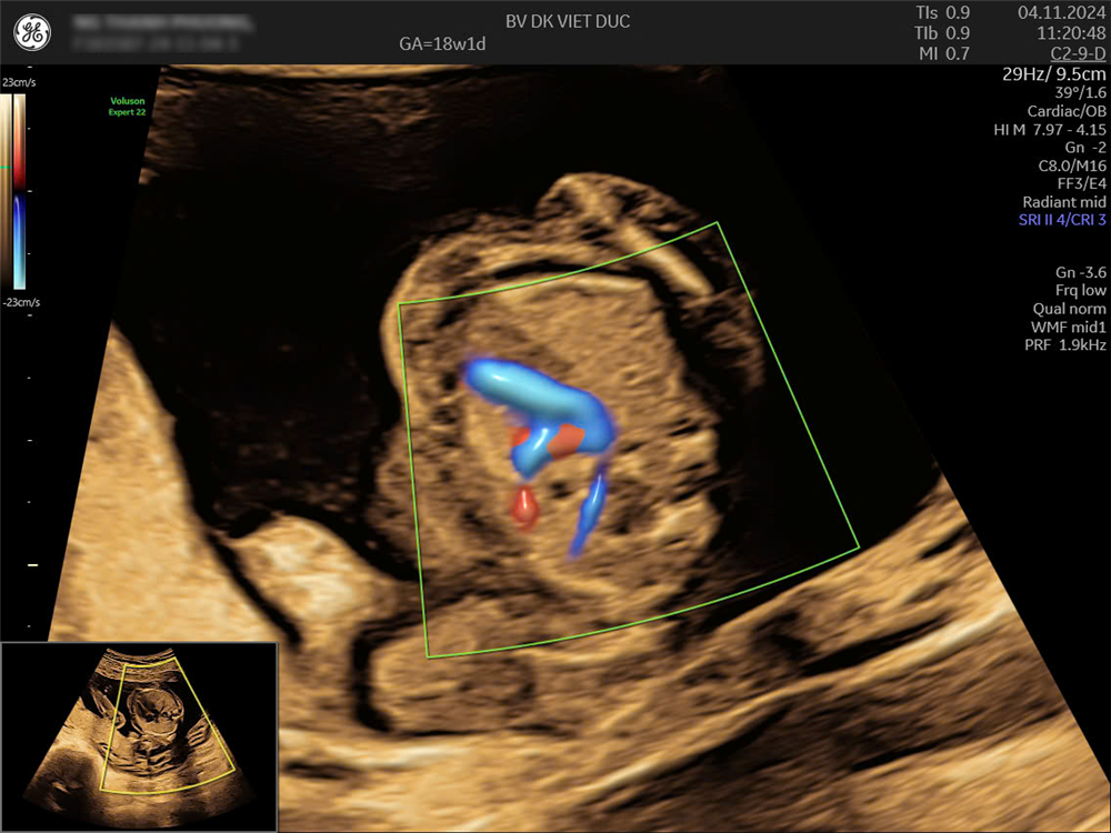 Phát hiện dị tật bẩm sinh thai kỳ qua siêu âm hình thái tại Bệnh viện Đa khoa Việt Đức