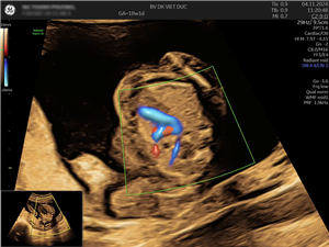 Phát hiện dị tật bẩm sinh thai kỳ qua siêu âm hình thái tại Bệnh viện Đa khoa Việt Đức