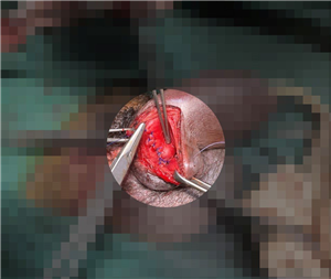 Bệnh viện đa khoa Việt Đức phẫu thuật cấp cứu vỡ vật hang do gãy dương vật