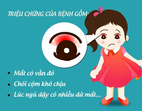 Khuyến cáo phòng chống bệnh đau mắt đỏ