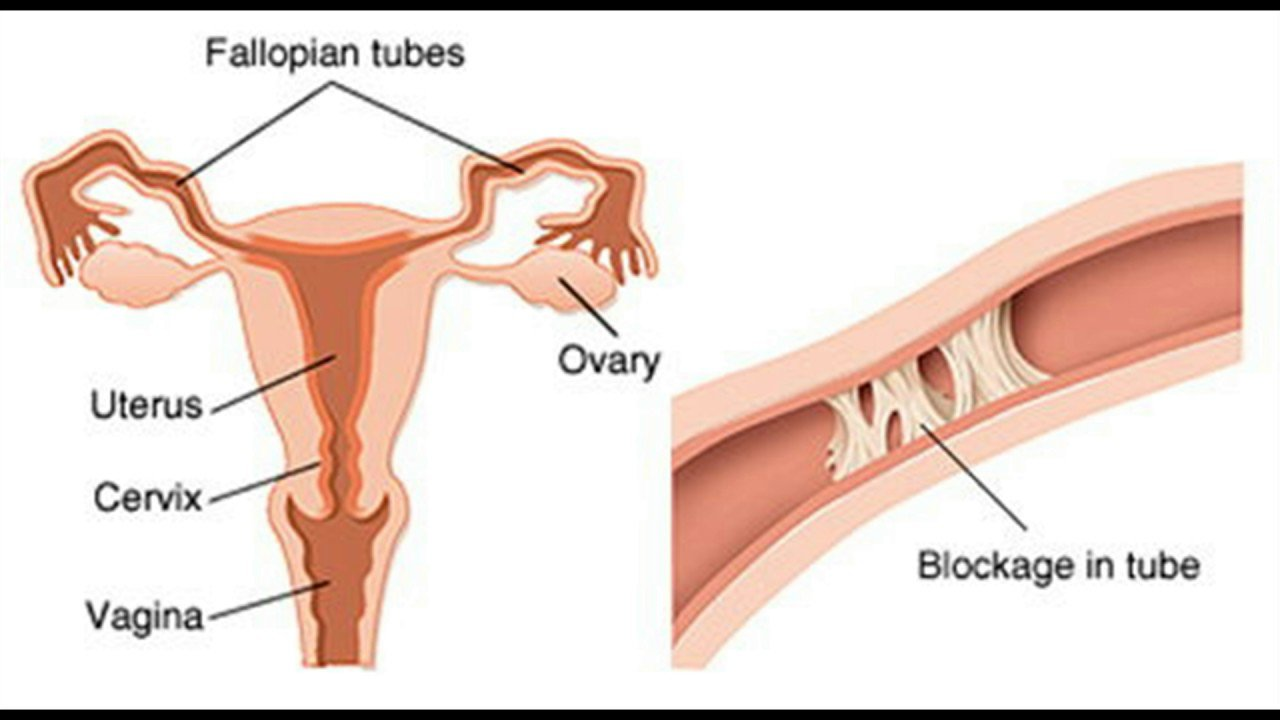 Chụp X-quang tử cung vòi trứng giúp chẩn đoán hiếm muộn ở nữ