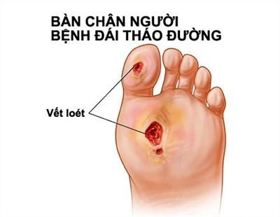 Hướng dẫn chăm sóc bàn chân bệnh nhân tiểu đường