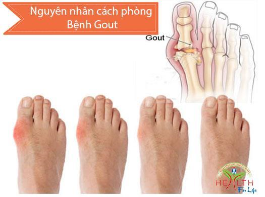 Bệnh gút (Gout), Nguyên nhân cách phòng Bệnh gout