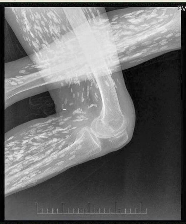 Rầm rộ bức ảnh chụp bằng X-quang của bệnh nhân nhiễm sán xơ mít