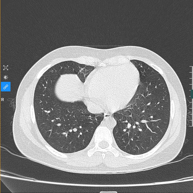 Viêm phổi thùy ở trẻ em, biến chứng nguy hiểm khó lường
